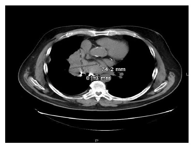 Atipik pulmoner karsinoid: yayımlanmış olgu görüntüsü, aksiyel kesit