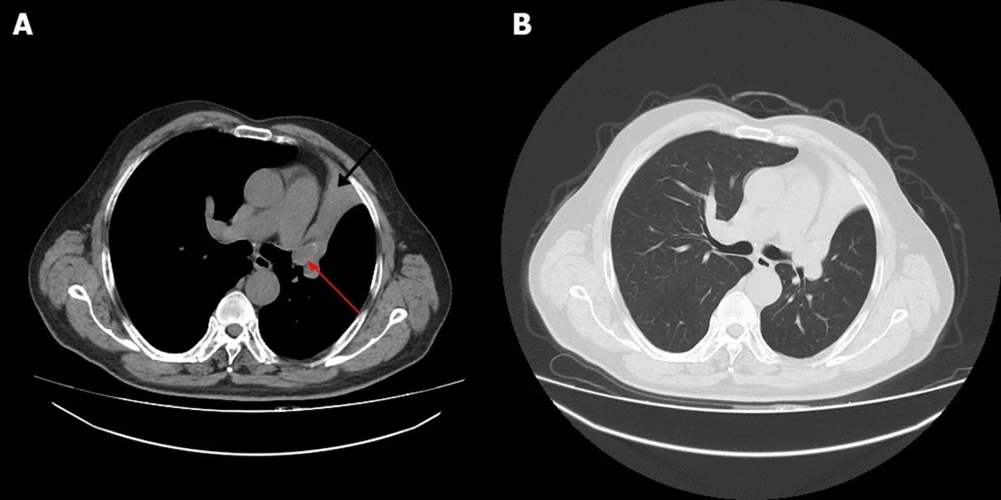 Endobronşiyal metastaz: yayımlanmış olgu görüntüsü, aksiyel kesit