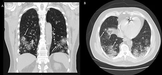Kavitasyonlu pulmoner metastazlar: yayımlanmış olgu görüntüsü, koronal kesit