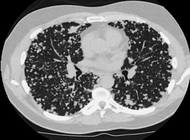 Miliyer pulmoner metastaz paterni: yayımlanmış olgu görüntüsü, aksiyel kesit