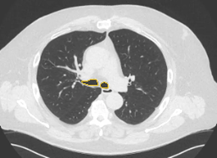 Bölge anatomisi, BT kesiti: Trakea sınırı sarı çizgiyle işaretli