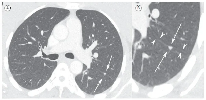 Perifissüral/intrapulmoner lenf nodu: yayımlanmış olgu görüntüsü, aksiyel kesit