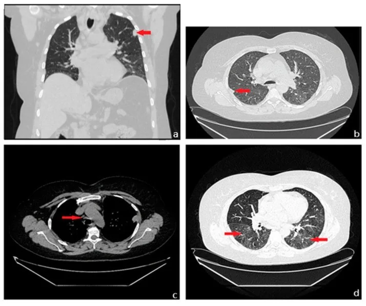 Nodüler pulmoner amiloidoz (amyloidoma): yayımlanmış olgu görüntüsü, aksiyel kesit