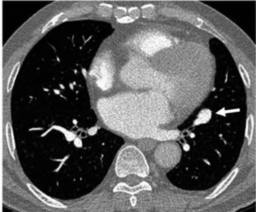 Pulmoner arter anevrizması/psödoanevrizması: yayımlanmış olgu görüntüsü, koronal kesit