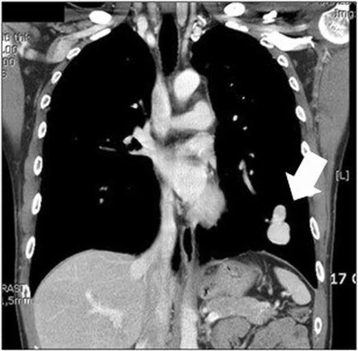 Pulmoner arteriovenöz malformasyon: yayımlanmış olgu görüntüsü, aksiyel kesit