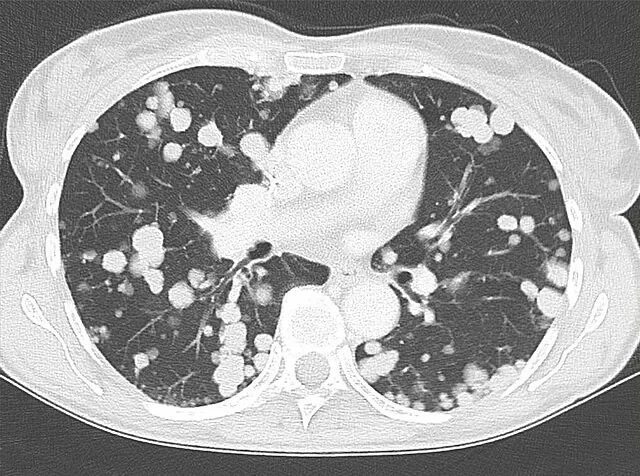 Hematojen pulmoner metastazlar (rastgele dağılım): yayımlanmış olgu görüntüsü, aksiyel kesit