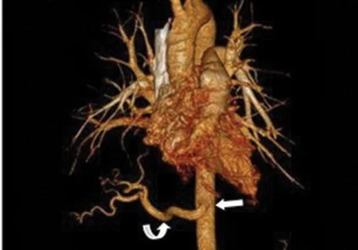 Pulmoner sekestrasyon: yayımlanmış olgu görüntüsü, aksiyel kesit