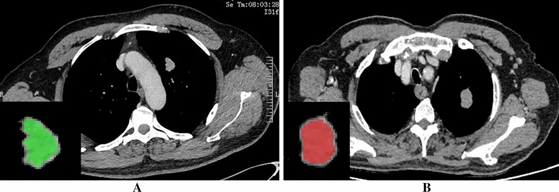 Pulmoner sklerozan pnömositom: yayımlanmış olgu görüntüsü, aksiyel kesit