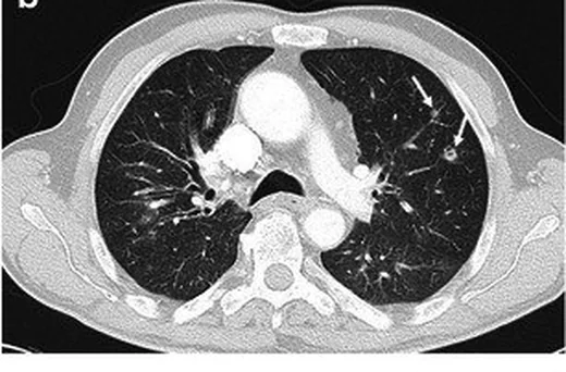 Septik pulmoner emboli nodül taklitçisi: yayımlanmış olgu görüntüsü, aksiyel kesit
