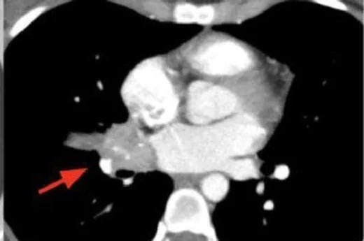Tipik pulmoner karsinoid: yayımlanmış olgu görüntüsü, aksiyel kesit