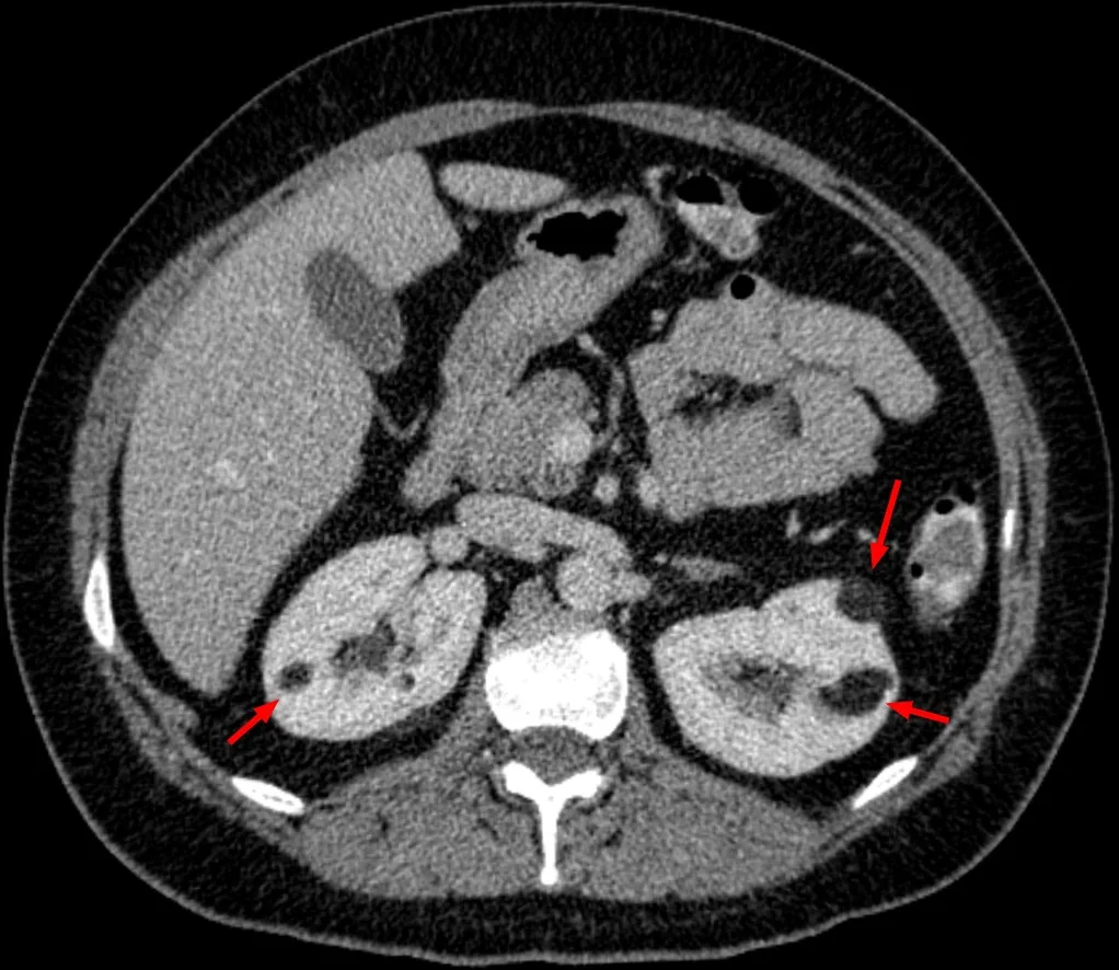 Renal anjiyomiyolipom: yayımlanmış olgu görüntüsü, aksiyel kesit