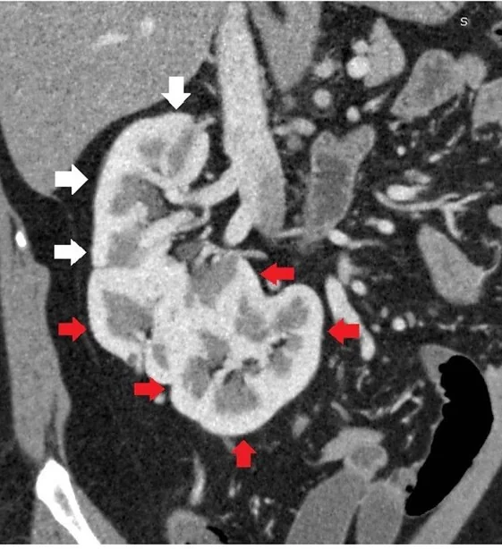 Çapraz füzyonlu renal ektopi: yayımlanmış olgu görüntüsü, koronal kesit