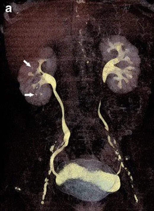 Renal papiller nekroz: yayımlanmış olgu görüntüsü, koronal kesit