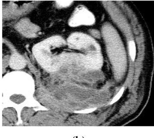 Renal ve perinefrik apse: yayımlanmış olgu görüntüsü, aksiyel kesit