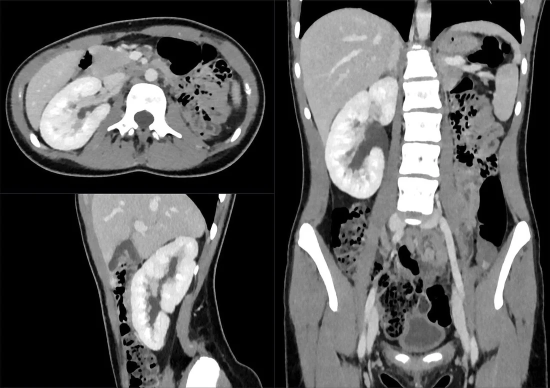 Renal agenezi ve hipoplazi: yayımlanmış olgu görüntüsü, koronal kesit