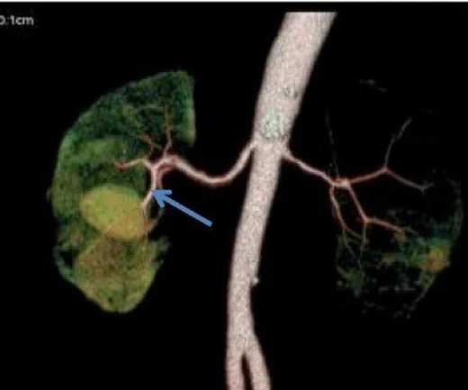 Renal arter anevrizması ve psödoanevrizma: yayımlanmış olgu görüntüsü, 3B kesit