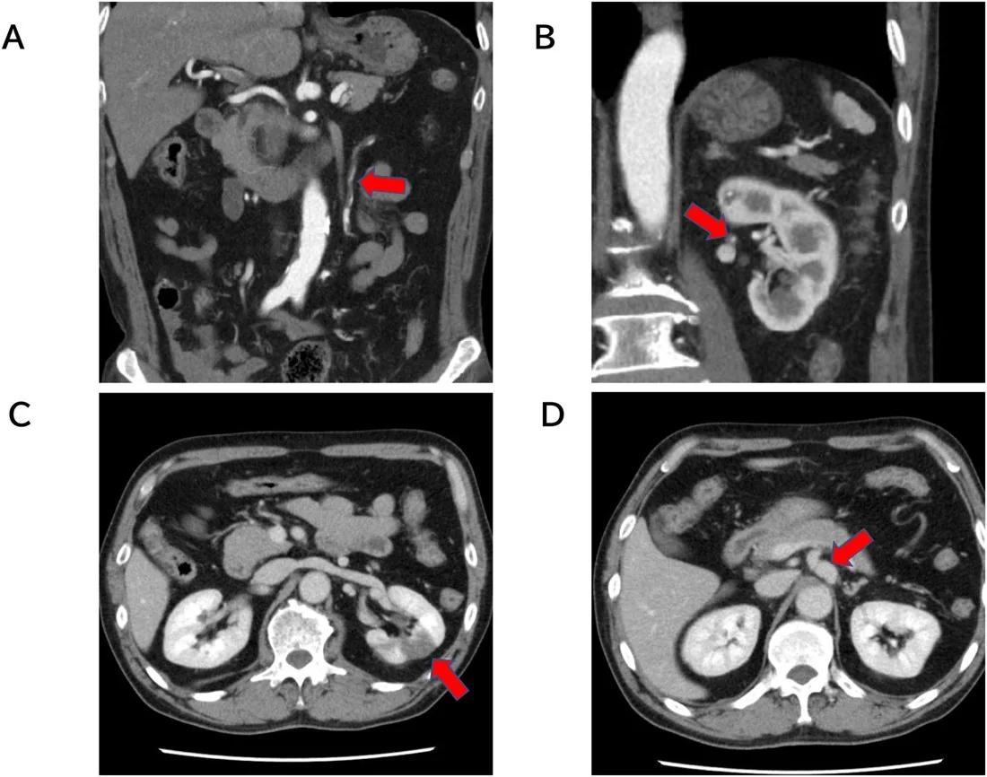 Renal arter diseksiyonu ve trombozu: yayımlanmış olgu görüntüsü, koronal kesit