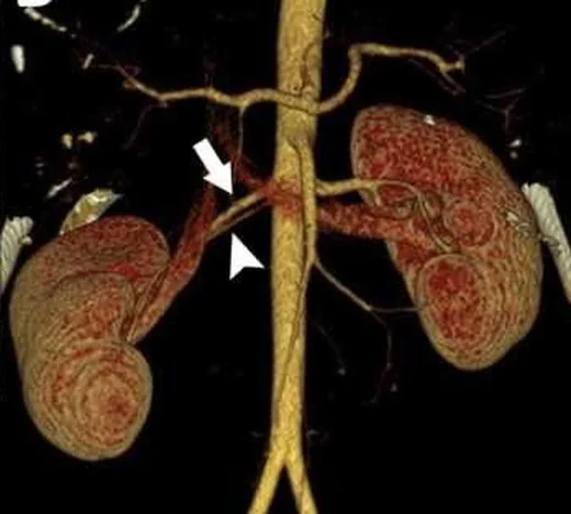 Aksesuar renal arter ve erken dallanma: yayımlanmış olgu görüntüsü, 3B kesit