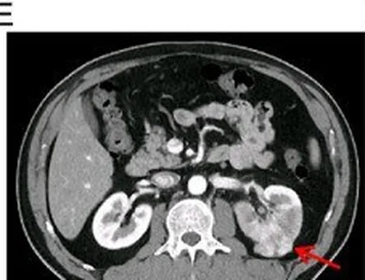 Renal hücreli karsinomun BT’de böbrek görünümü: yayımlanmış olgu görüntüsü, aksiyel kesit