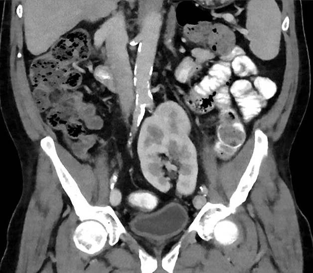 Renal ektopi ve çapraz ektopi: yayımlanmış olgu görüntüsü, aksiyel ve koronal kesit