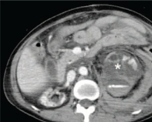 Spontan renal/perirenal kanama: yayımlanmış olgu görüntüsü, aksiyel kesit