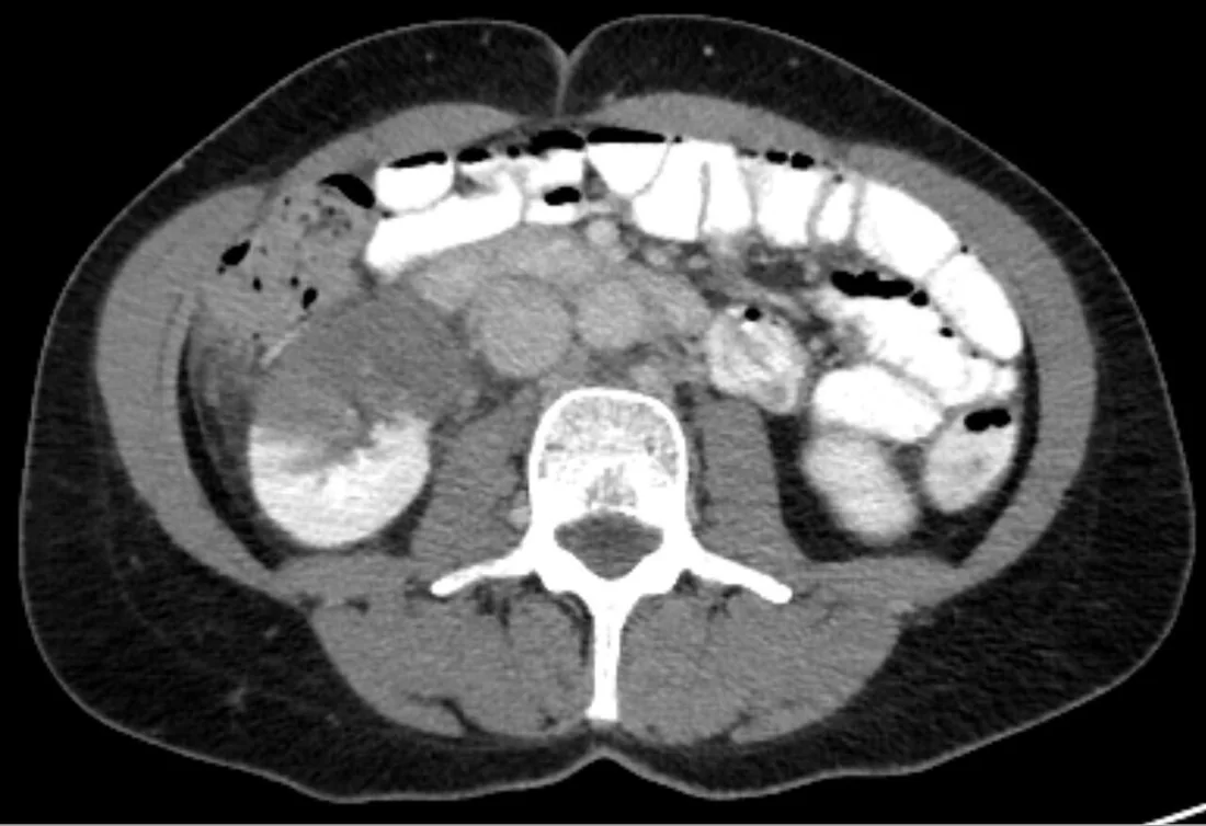 Renal infarkt: yayımlanmış olgu görüntüsü, aksiyel kesit