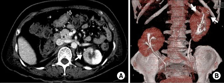 Renal malrotasyon: yayımlanmış olgu görüntüsü, 3B kesit