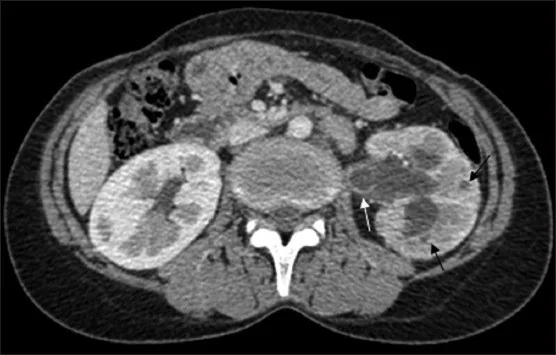 Renal tüberküloz: yayımlanmış olgu görüntüsü, aksiyel kesit