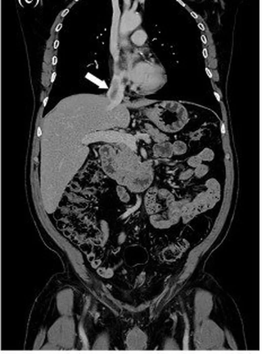 Renal tümör trombüsü: yayımlanmış olgu görüntüsü, koronal kesit