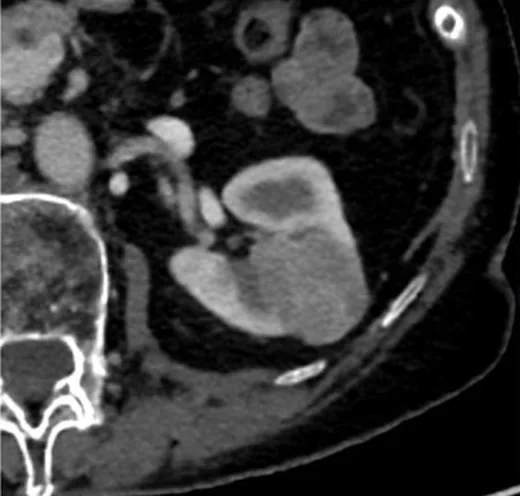 Kromofob renal hücreli karsinom: yayımlanmış olgu görüntüsü, aksiyel kesit