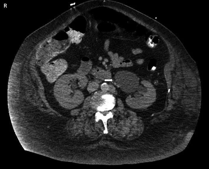 Ekstrarenal pelvis: yayımlanmış olgu görüntüsü, aksiyel kesit