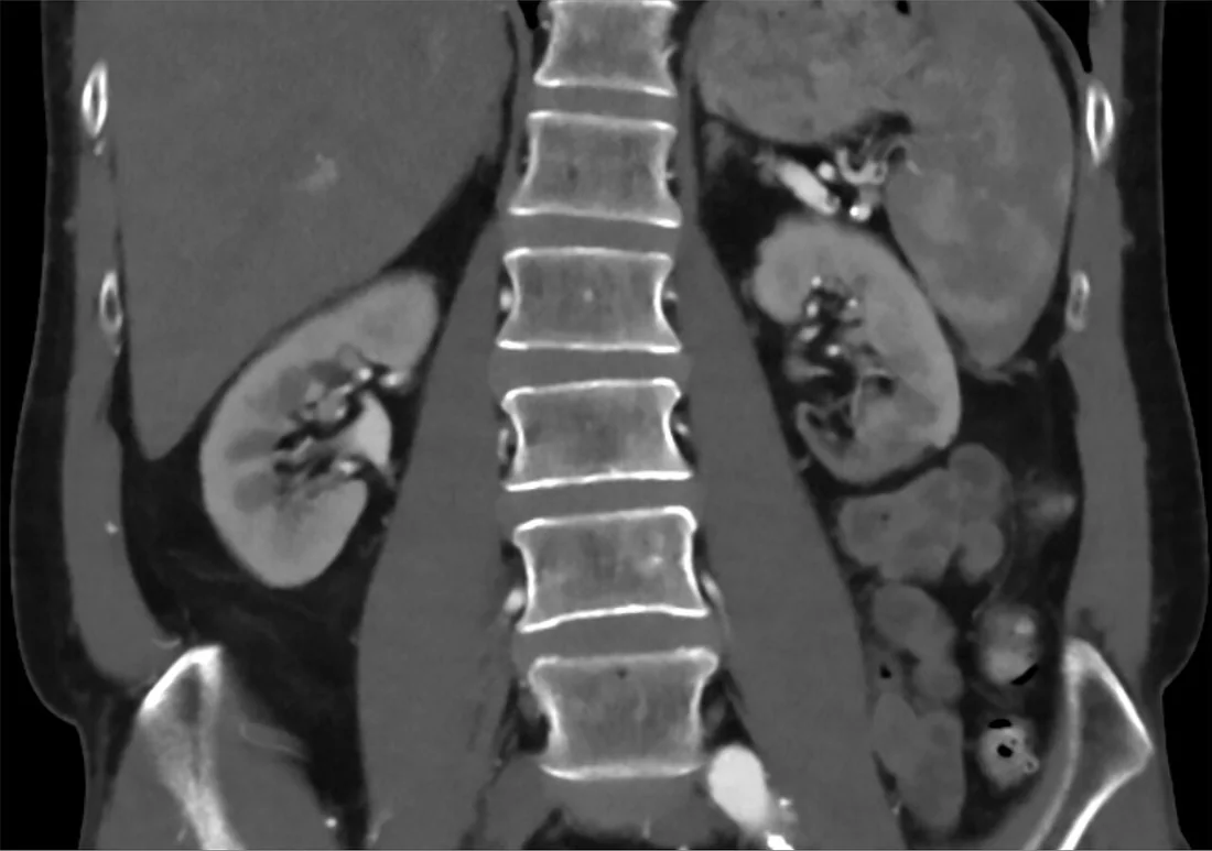 Renal infarkt psödokitle: yayımlanmış olgu görüntüsü, koronal kesit