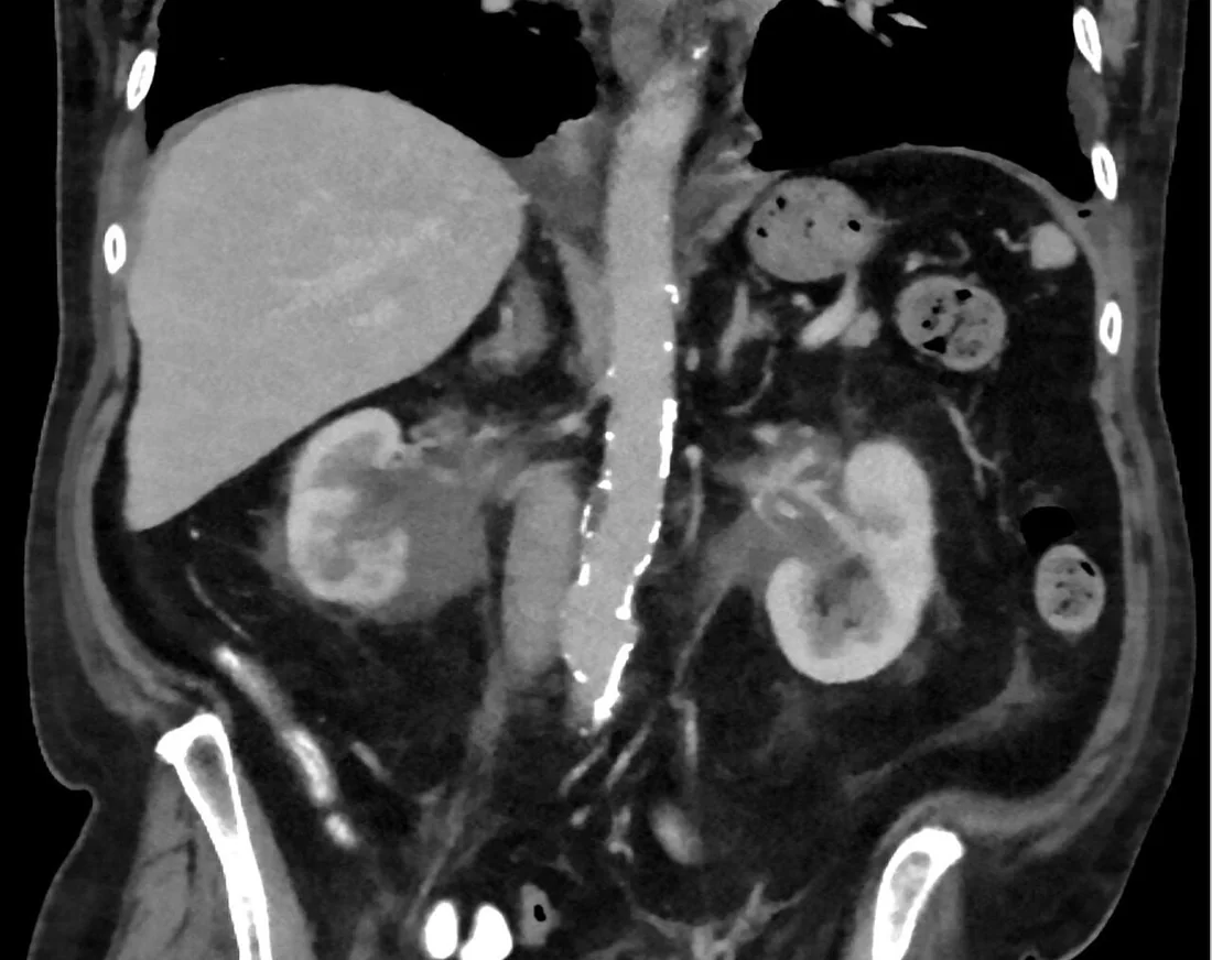 Renal lenfoma: yayımlanmış olgu görüntüsü, koronal kesit