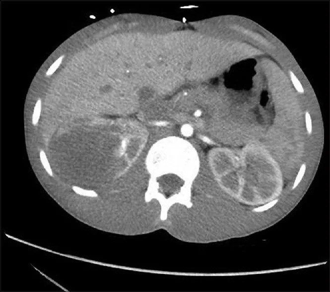 SMARCB1 (INI1)-eksik renal medüller karsinom: yayımlanmış olgu görüntüsü, aksiyel kesit