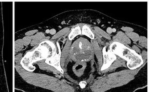 Akut prostatit ve komplikasyonları: yayımlanmış olgu görüntüsü, aksiyel kesit