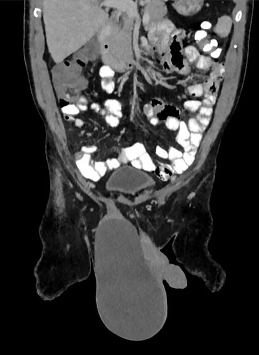 Hidrosel ve hematosel: yayımlanmış olgu görüntüsü, aksiyel+koronal+sagittal kesit