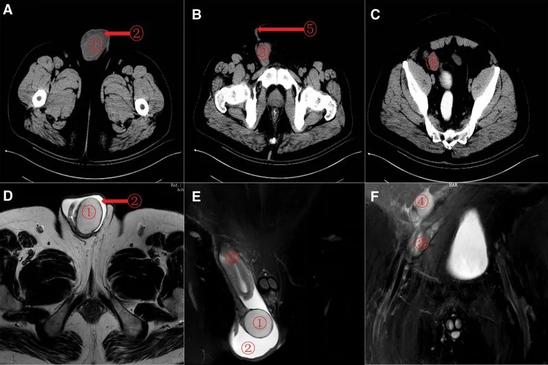 İnmemiş/ektopik testis: tesadüfi BT bulgusu: yayımlanmış olgu görüntüsü, aksiyel kesit