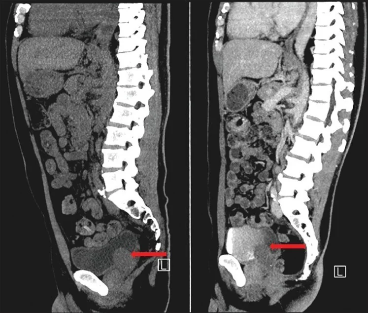 Seminal vezikül kisti ve Zinner sendromu: yayımlanmış olgu görüntüsü, sagittal kesit