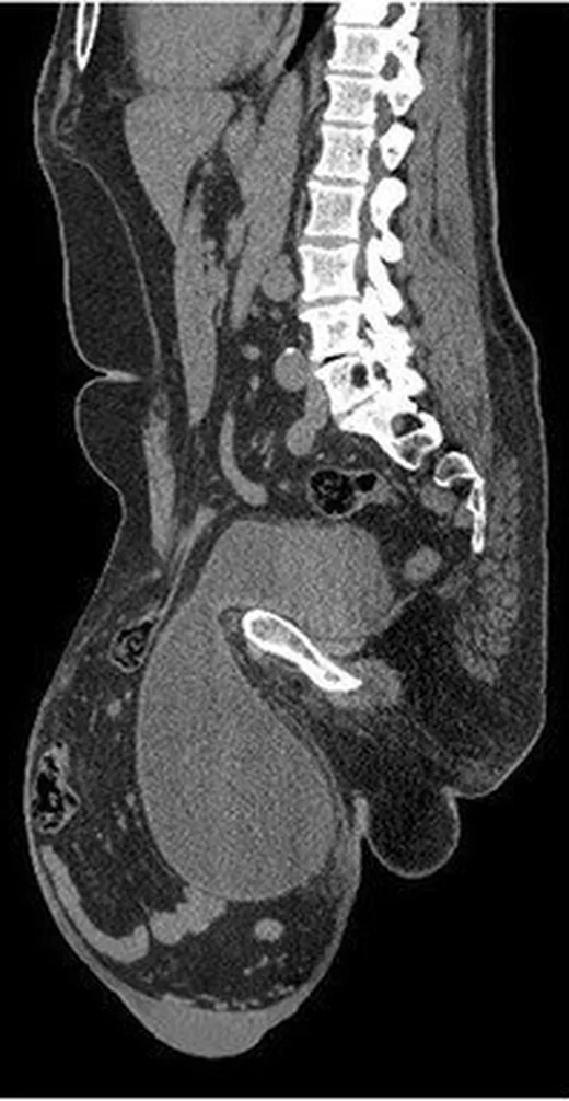 İnguinoskrotal herni: yayımlanmış olgu görüntüsü, koronal+sagittal kesit