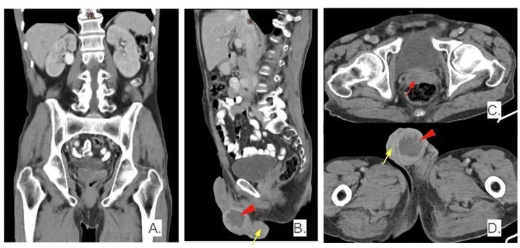 Testis/epididim apsesi ve enfarkt taklitçisi: yayımlanmış olgu görüntüsü, sagittal+aksiyel kesit