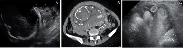 Over endometrioması: yayımlanmış olgu görüntüsü, aksiyel kesit