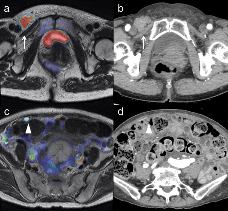 Endometrium kanserinde yayılım değerlendirmesi: yayımlanmış olgu görüntüsü, aksiyel kesit