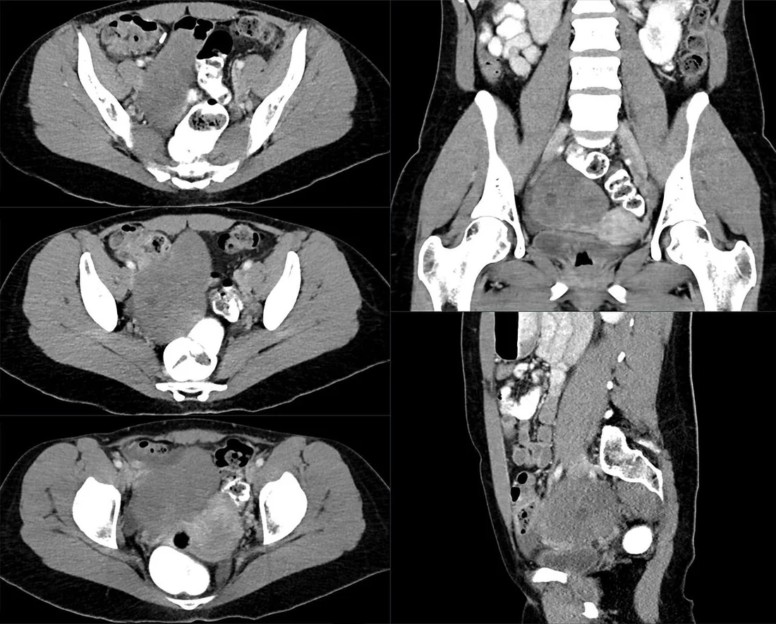 Over fibrom/tekomu ve Meigs örüntüsü: yayımlanmış olgu görüntüsü, aksiyel kesit