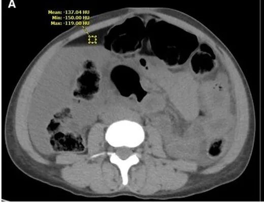 Over kitlesi/dermoid rüptürü: yayımlanmış olgu görüntüsü, aksiyel+sagittal kesit