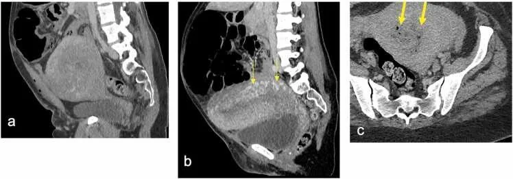 Postpartum pelvik komplikasyonlar ve normal postpartum görünüm: yayımlanmış olgu görüntüsü, sagittal kesit