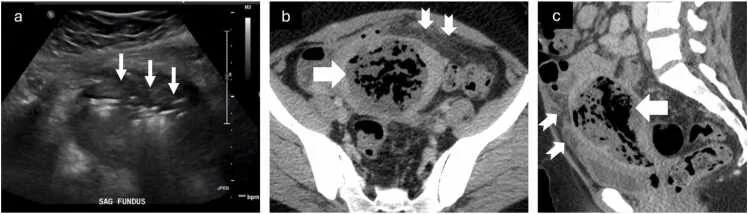 Retained products of conception ve postpartum endometrit: yayımlanmış olgu görüntüsü, aksiyel kesit