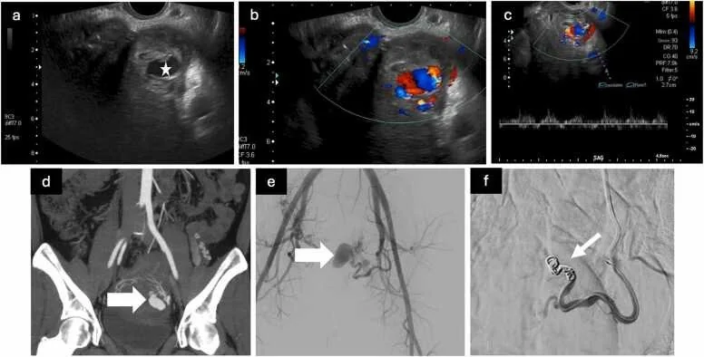Uterin arteriovenöz malformasyon ve psödoanevrizma: yayımlanmış olgu görüntüsü, koronal kesit