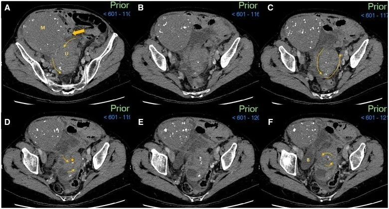 Uterus torsiyonu: yayımlanmış olgu görüntüsü, aksiyel kesit