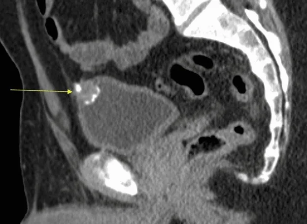 Urakal adenokarsinomu: yayımlanmış olgu görüntüsü, sagittal kesit