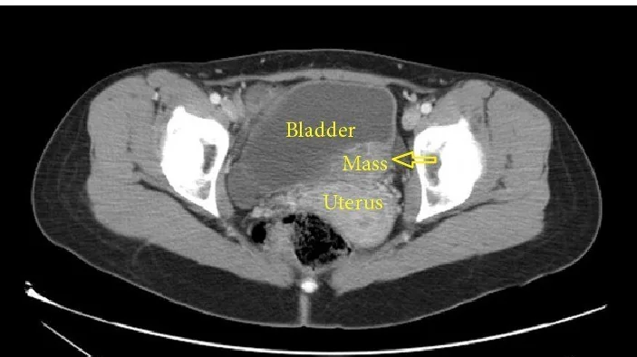 Mesane endometriozisi: yayımlanmış olgu görüntüsü, aksiyel kesit